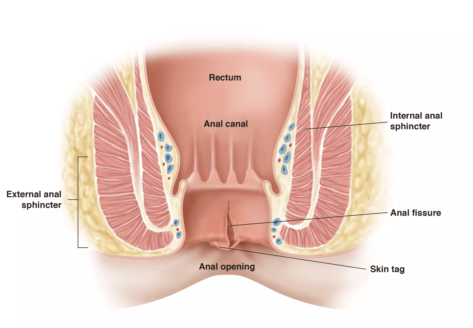 Anal Fissure Overview