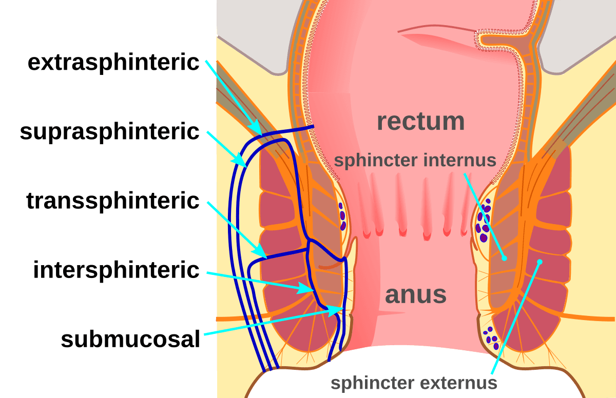 Diagram of Fistula Types