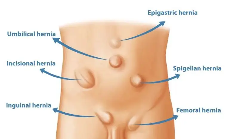Hernia Treatment Overview