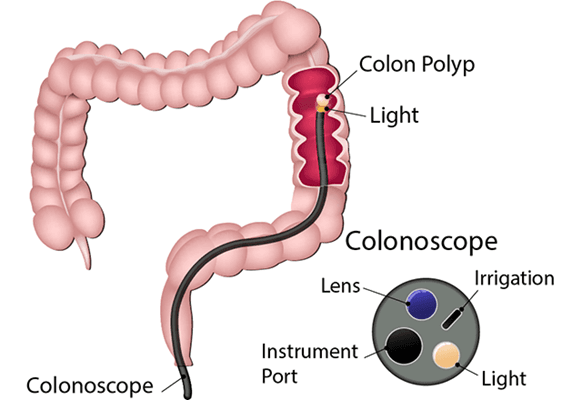 Colonoscopy Procedure