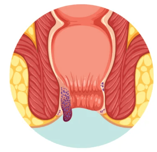 Grade IV Piles illustration