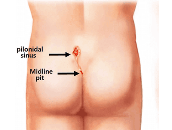 Pilonidal Sinus Overview