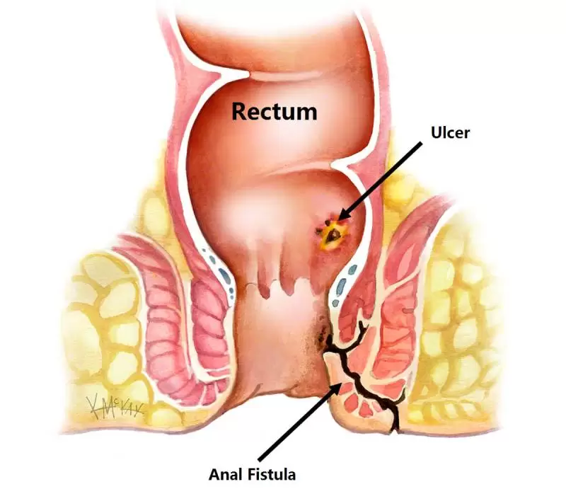 Anal Fistula Overview