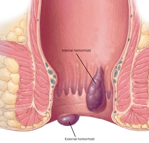 Laser Proctology