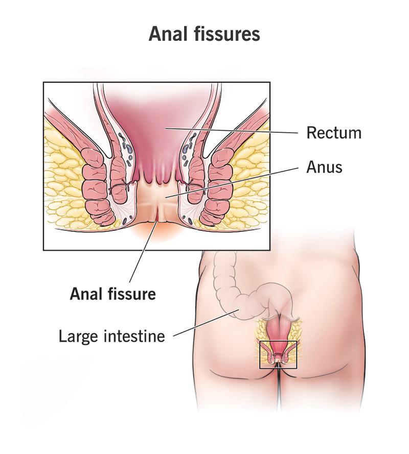 Laser Proctology