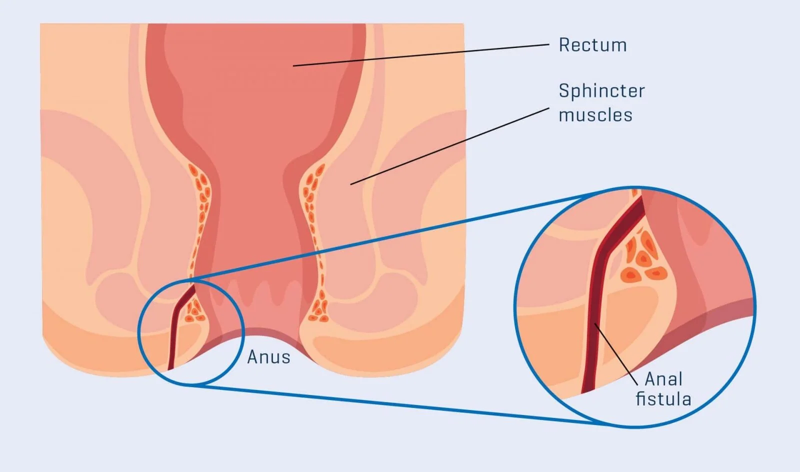 Laser Proctology