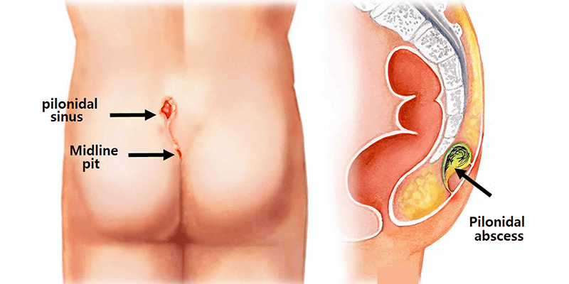 Laser Proctology