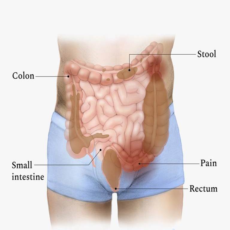 Laser Proctology