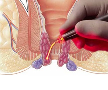 Laser Proctology