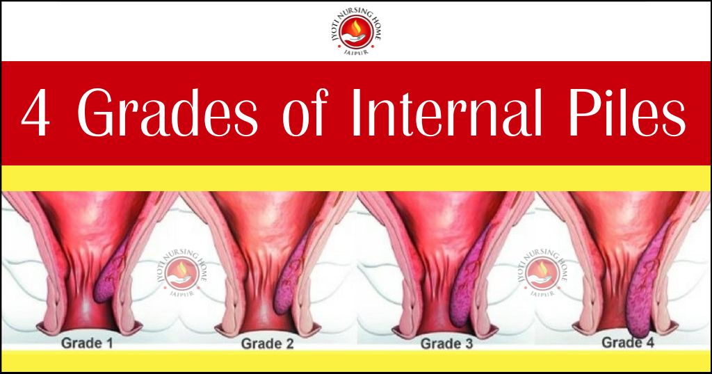 Piles (Hemorrhoids)