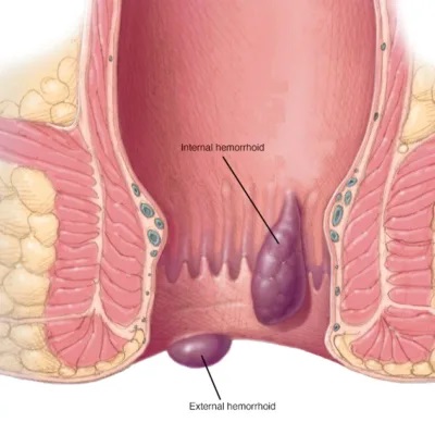 Piles (Hemorrhoids)