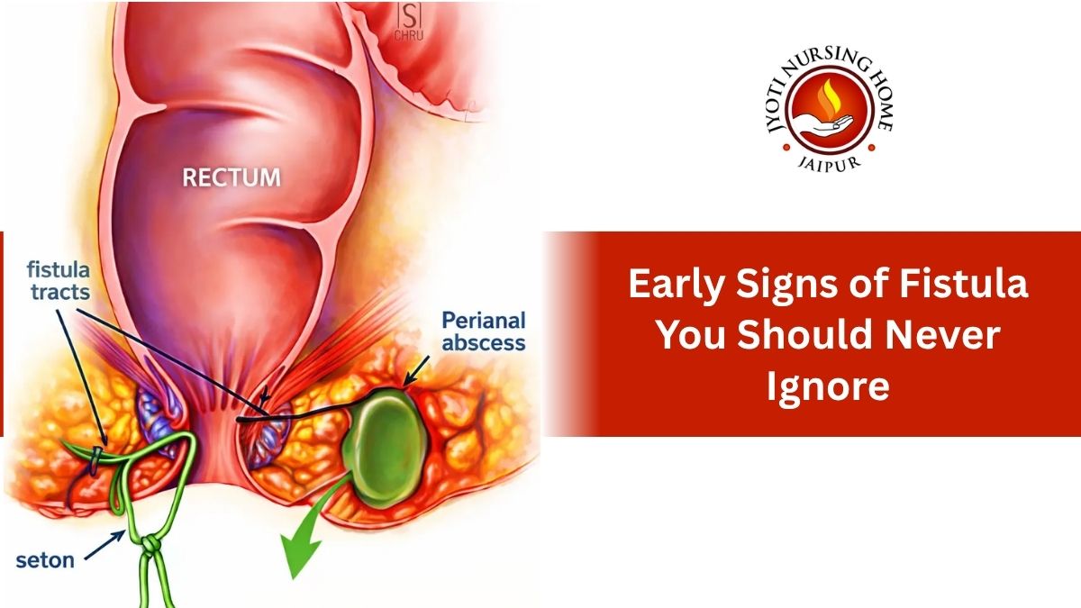 Early Signs of Fistula You Should Never Ignore